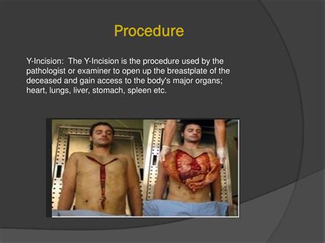 What type of incision is used in an autopsy The Coronal incision Is the commonly employed skin incision employed to open up the cranial cavity. . Autopsy incision types